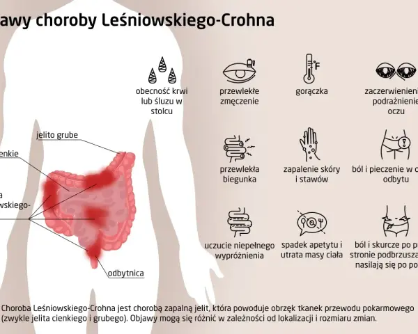 Objawy choroby Leśniowskiego-Crohna: ból brzucha, biegunka, zmęczenie, gorączka, problemy ze skórą i oczami.