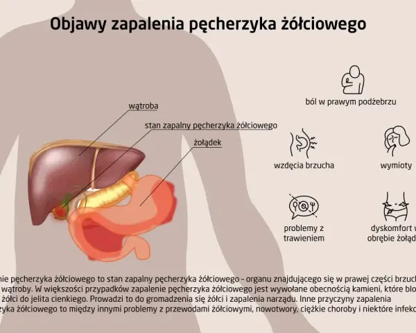 Ilustracja przedstawia anatomię jamy brzusznej z zaznaczonym pęcherzykiem żółciowym, wątrobą i żołądkiem. Opisuje objawy zapalenia pęcherzyka żółciowego.