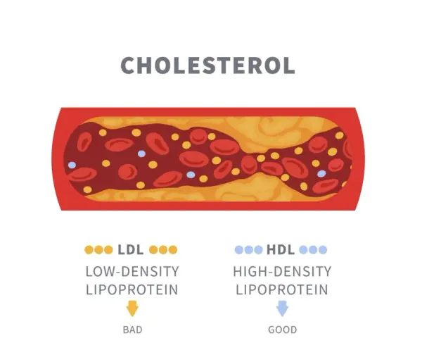 Przekrój naczynia krwionośnego z osadem cholesterolowym. Obok oznaczenia LDL (zły) i HDL (dobry) wskazują na normę cholesterolu całkowitego.