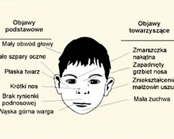 Objawy FAS: Jak je rozpoznać i skutecznie pomóc dziecku?