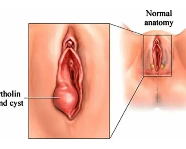 Ilustracja pokazuje cystę gruczołu Bartholina, która jest powiększona w porównaniu do normalnej anatomii.