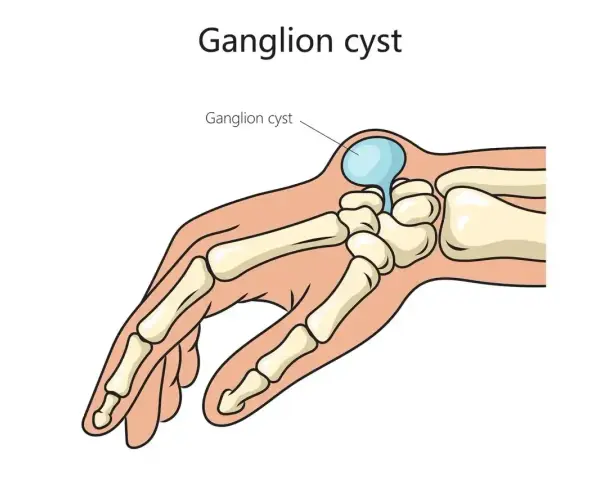 Przekrój dłoni ukazujący kości i ganglion.