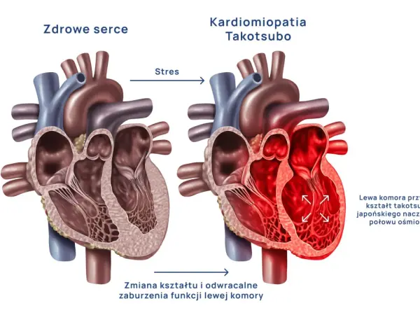 Syndrom złamanego serca: Czy to zawał? Objawy i leczenie