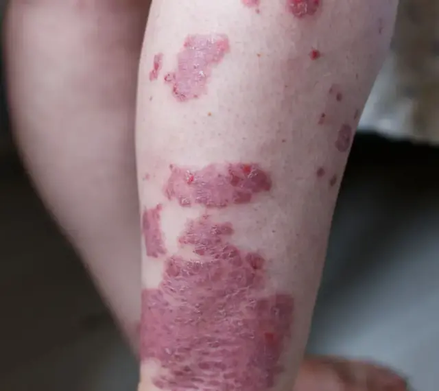 Widoczne czerwone plamy na skórze nogi, niektóre łuszczące się, wskazujące na problem dermatologiczny.