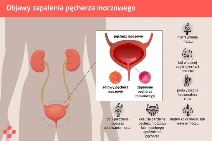 Pieczenie przy sikaniu? Jakie leki na zapalenie cewki moczowej?