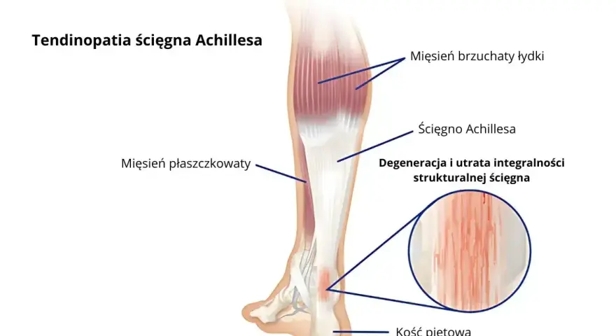 Anatomia łydki z zaznaczonym ścięgnem Achillesa, mięśniami i kością piętową. Widoczna degeneracja ścięgna.