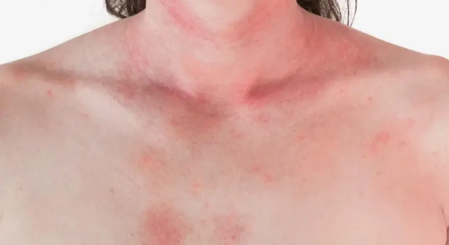 Czy truskawki uczulają? Alergia, nietolerancja objawy i leczenie