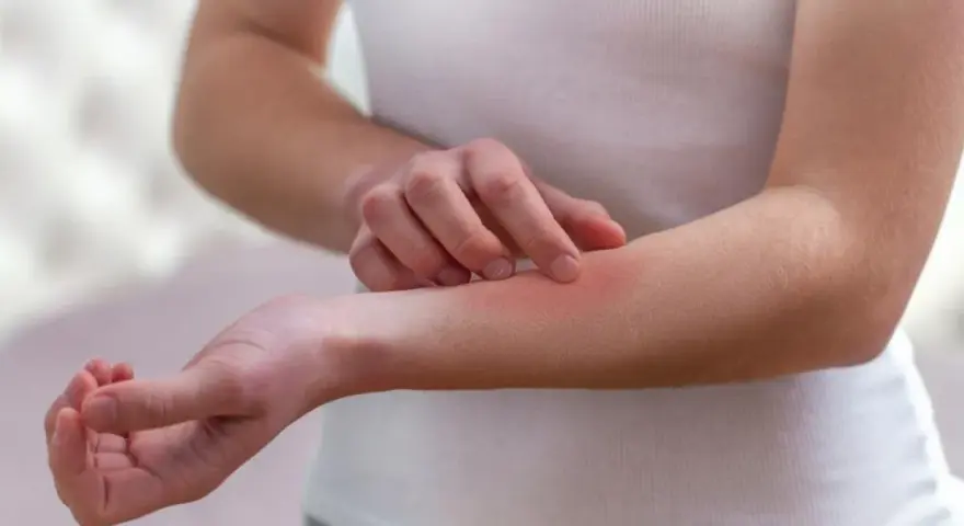 Dłoń drapiąca zaczerwienioną skórę na przedramieniu, objaw mogący wskazywać na lupus.