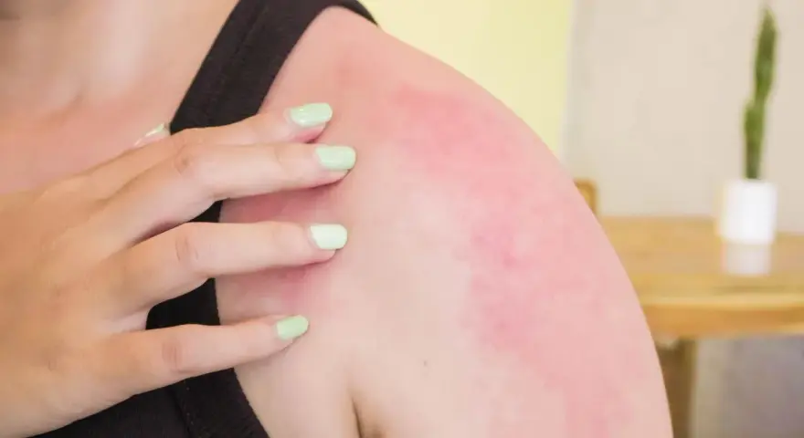 Alergia na wodę? Poznaj prawdziwe przyczyny swędzenia po prysznicu.