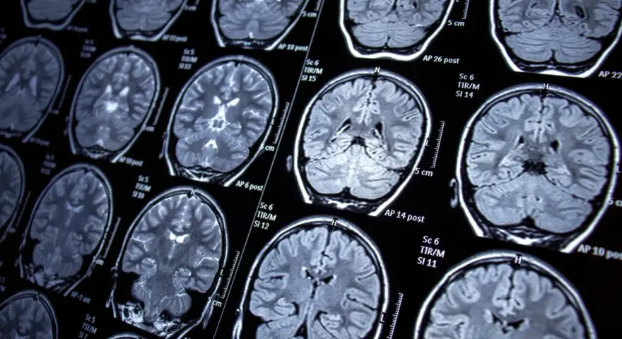 Przekroje mózgu na rezonansie magnetycznym, ukazujące jego strukturę. Badanie może pomóc w diagnozowaniu schorzeń, takich jak epilepsja.