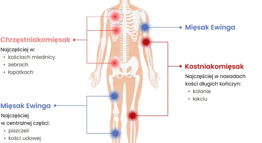 Schemat przedstawia lokalizację mięsaków: chrzęstniakomięsaka w miednicy, żebrach i łopatkach, a mięsaka Ewinga w piszczeli, kości udowej i ramiennej.