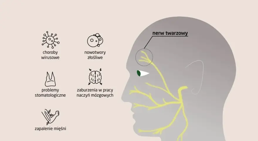 Ilustracja przedstawia przyczyny zapalenia nerwu twarzowego, w tym neuralgia nerwu trójdzielnego, choroby wirusowe, nowotwory, problemy stomatologiczne, zaburzenia naczyń mózgowych i zapalenie mięśni.
