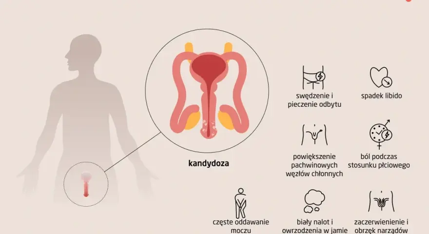 Ilustracja przedstawia objawy grzybicy penisa u mężczyzn, w tym zaczerwienienie, obrzęk narządów płciowych, ból podczas stosunku.