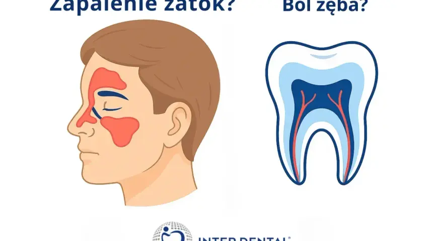 Zapalenie zatok czy ból zęba? Ilustracja pokazuje zatoki i przekrój zęba. Szukasz co na ból zęba?