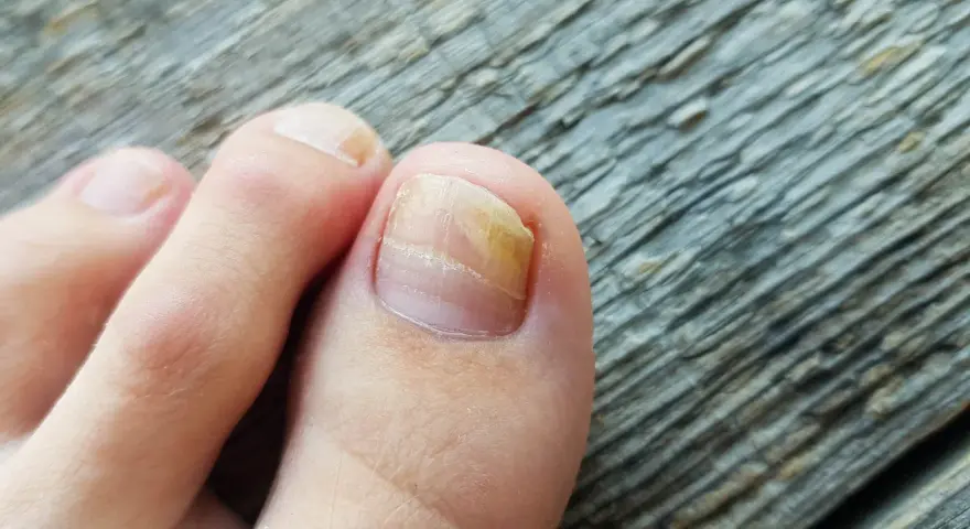 Grzybica paznokci: Kto pomoże? Dermatolog, podolog i skuteczne leczenie