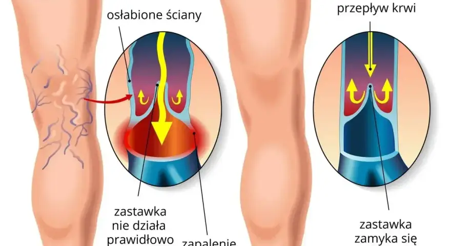 Ilustracja pokazuje nogę z żylakami i zdrową nogę. Flebolog wyjaśnia, że przy żylakach zastawki nie działają, powodując zapalenie.