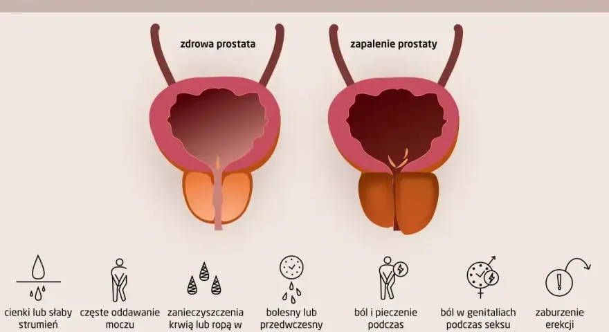 Porównanie zdrowej prostaty i zapalenia prostaty. Objawy zapalenia prostaty: słaby strumień moczu, ból, pieczenie, zaburzenia erekcji.