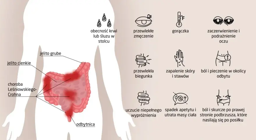 Objawy choroby Leśniowskiego-Crohna: ból brzucha, biegunka, zmęczenie, gorączka, problemy ze skórą i oczami.