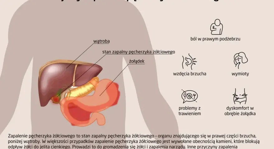Ilustracja przedstawia anatomię jamy brzusznej z zaznaczonym pęcherzykiem żółciowym, wątrobą i żołądkiem. Opisuje objawy zapalenia pęcherzyka żółciowego.