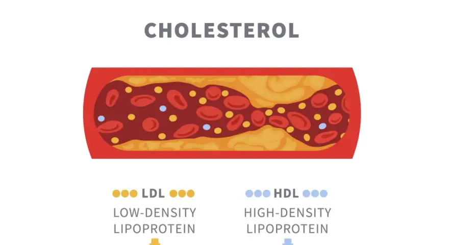 Przekrój naczynia krwionośnego z osadem cholesterolowym. Obok oznaczenia LDL (zły) i HDL (dobry) wskazują na normę cholesterolu całkowitego.