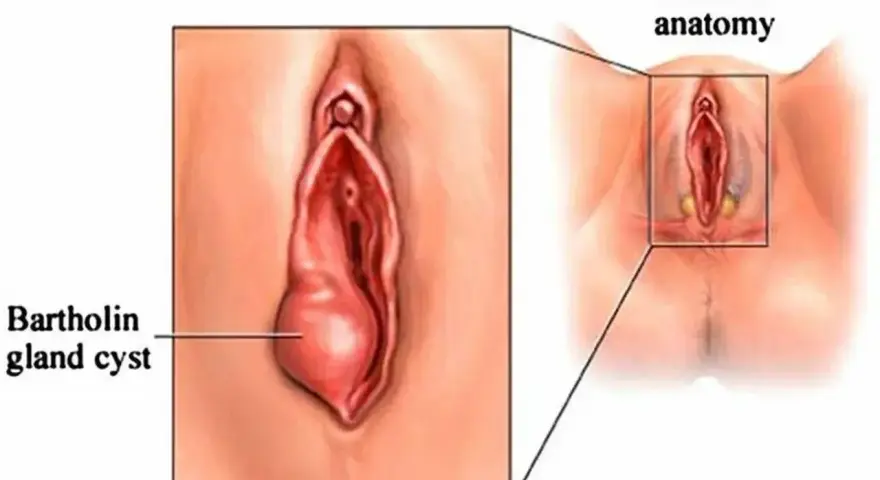 Ilustracja pokazuje cystę gruczołu Bartholina, która jest powiększona w porównaniu do normalnej anatomii.