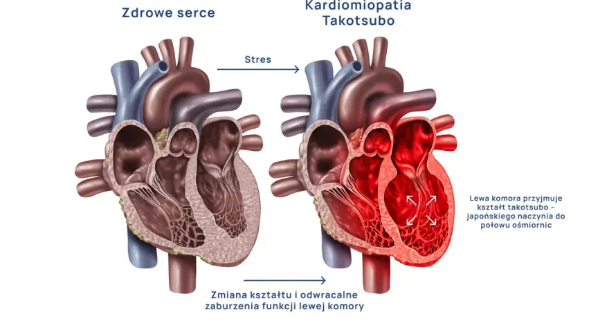 Syndrom złamanego serca: Czy to zawał? Objawy i leczenie