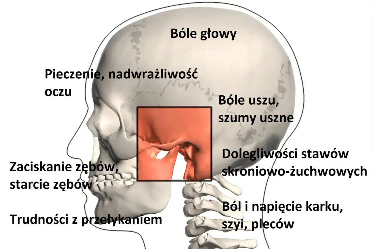 Schematyczny rysunek czaszki z zaznaczonym stawem skroniowo-żuchwowym, ilustrujący powiązane dolegliwości: bóle głowy, uszu, problemy z oczami, zaciskanie zębów, trudności z przełykaniem, bóle karku i pleców.