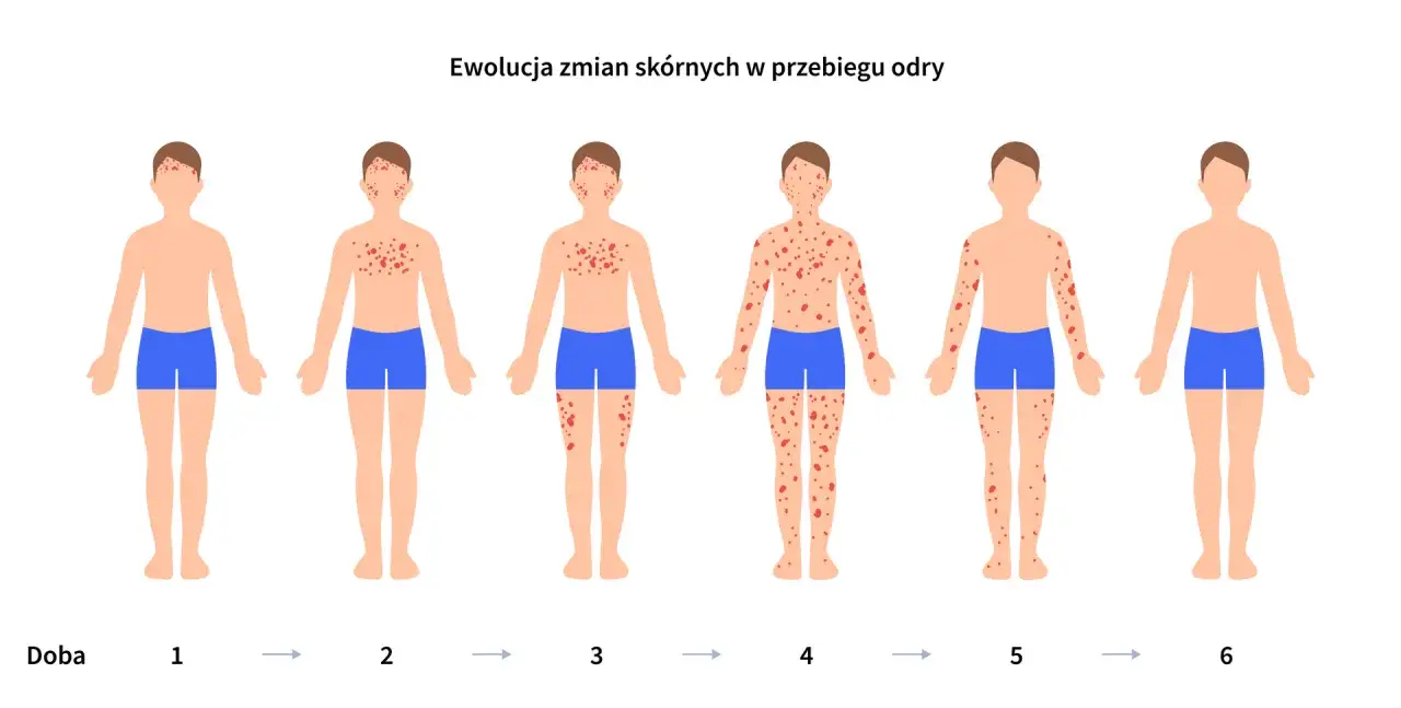 Ewolucja zmian skórnych w przebiegu odry: od 1. do 6. doby widoczna jest narastająca wysypka u dziecka, która następnie ustępuje.