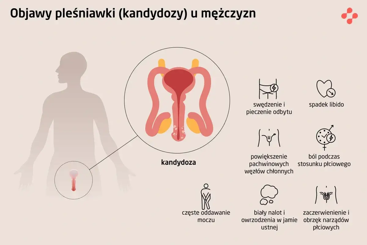Ilustracja przedstawia objawy grzybicy penisa u mężczyzn, w tym zaczerwienienie, obrzęk narządów płciowych, ból podczas stosunku i spadek libido.
