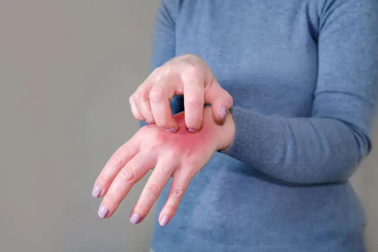 alergia na hybrydę vs akryl reakcja krzyżowa