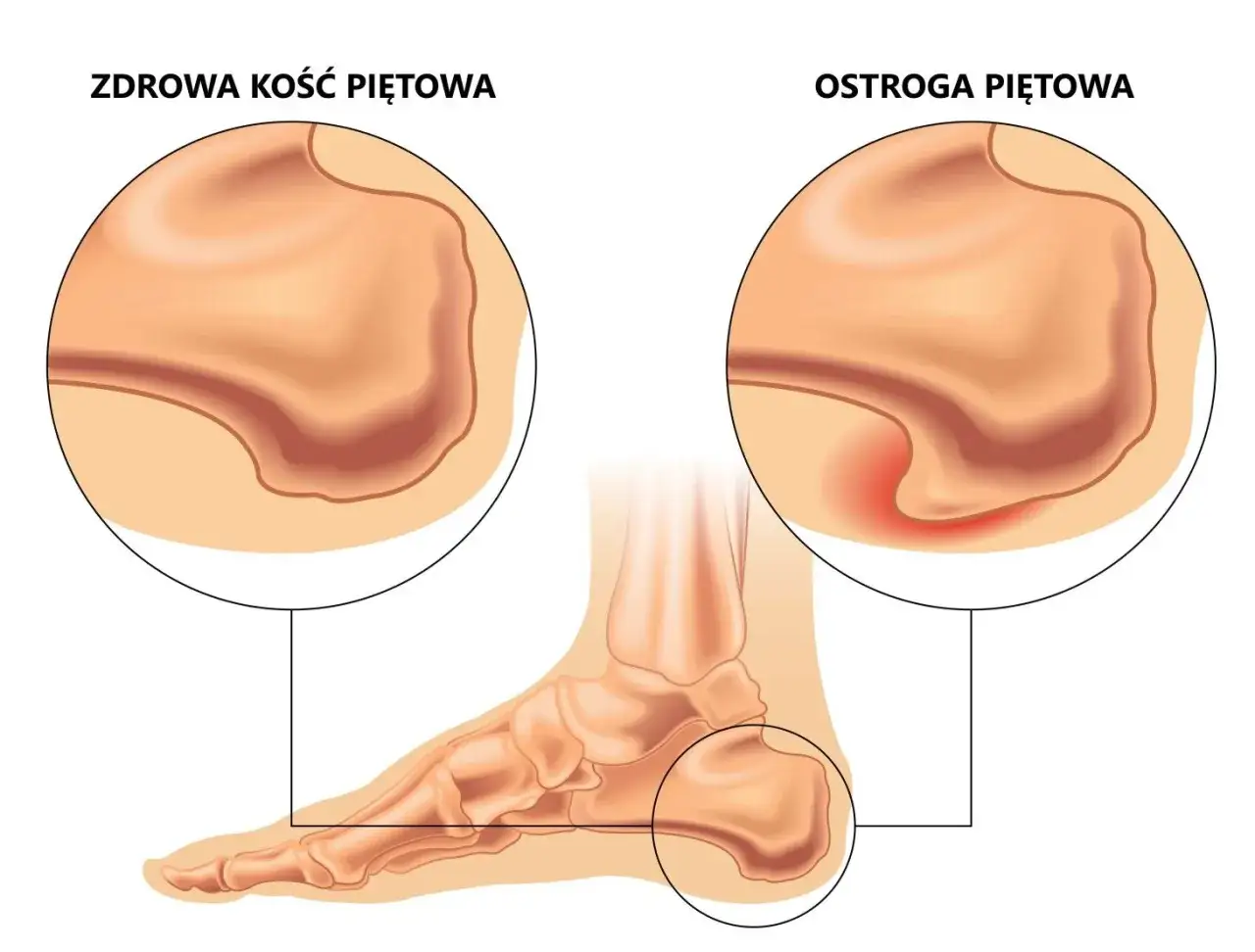 Anatomia stopy ostroga piętowa