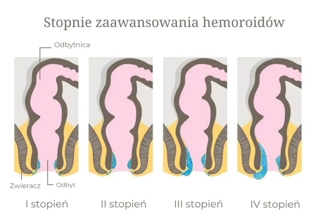 Ilustracja pokazuje cztery stadia rozwoju hemoroidów, od I do IV stopnia, uwidaczniając ich powiększanie się.