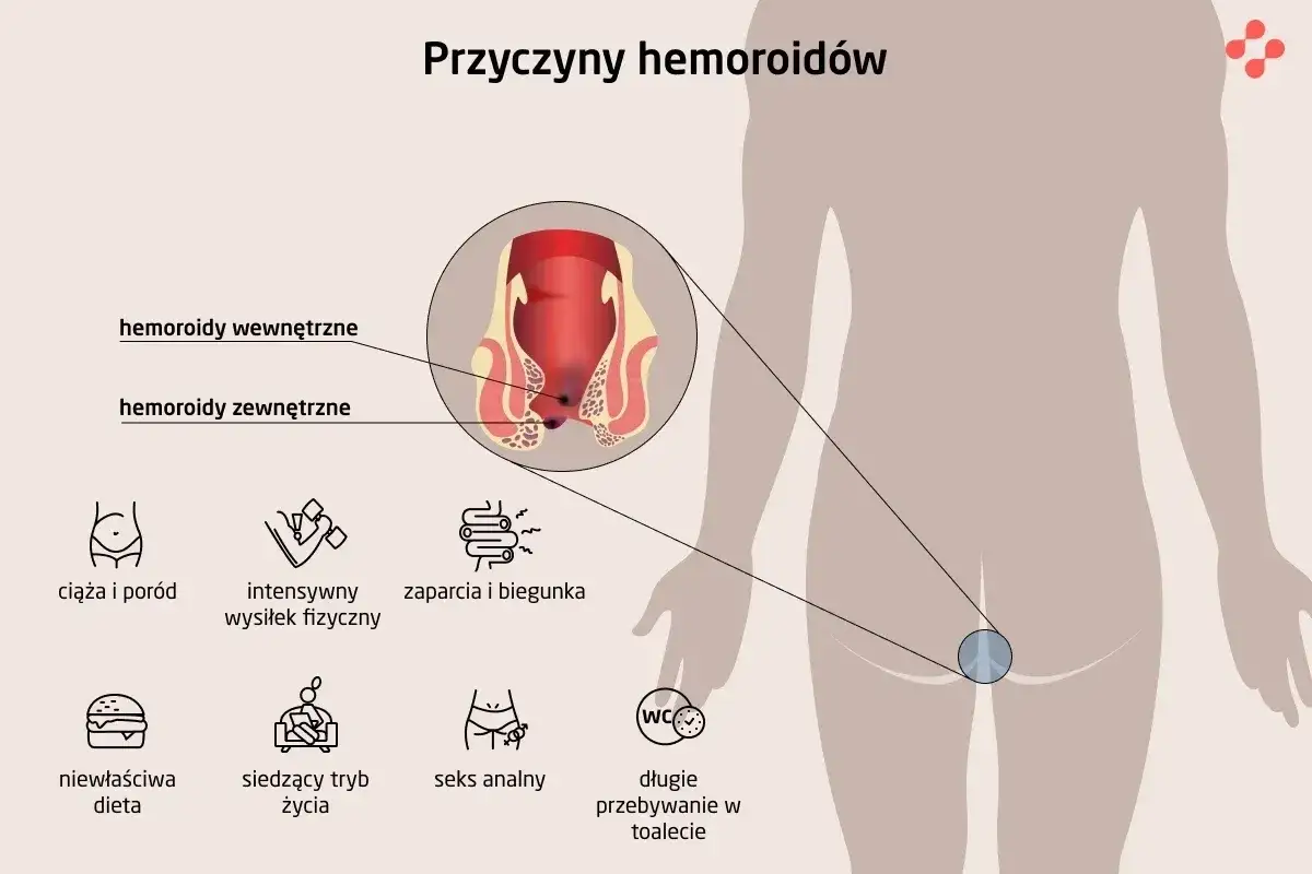 Ilustracja pokazuje, jak wyglądają hemoroidy wewnętrzne i zewnętrzne, oraz czynniki ryzyka: ciąża, wysiłek, zaparcia, dieta, siedzący tryb życia, seks analny, długie przebywanie w toalecie.