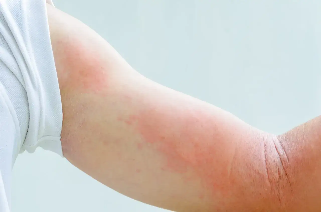 Diagnostyka alergii pokarmowej
