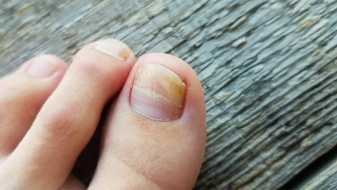 Dermatolog czy podolog grzybica paznokci