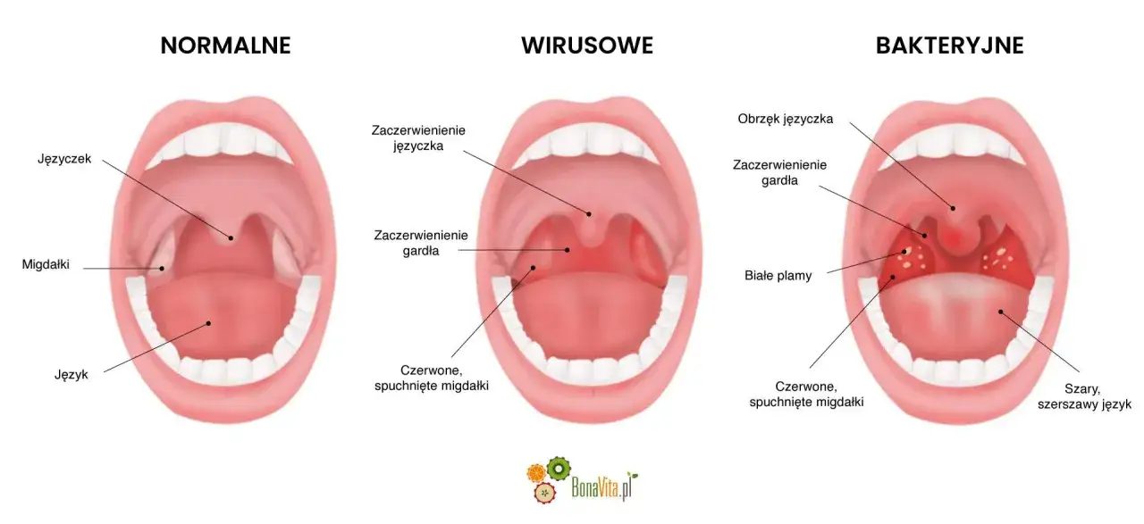 Porównanie gardła: normalne, wirusowe i bakteryjne. Angina paciorkowcowa objawia się białymi plamami na migdałkach.