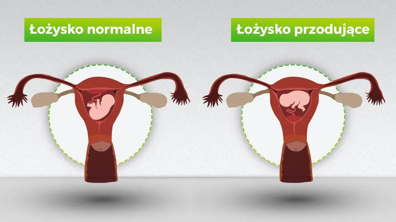 Porównanie: łożysko normalne vs łożysko przodujące. Grafika pokazuje macicę z płodem i jego łożyskiem w dwóch wariantach.