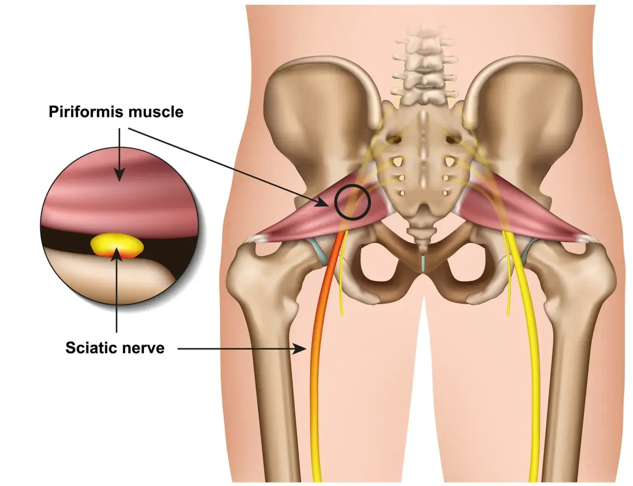 Anatomia miednicy z zaznaczonym mięśniem gruszkowatym i nerwem kulszowym, który może uciskać staw krzyżowo biodrowy.