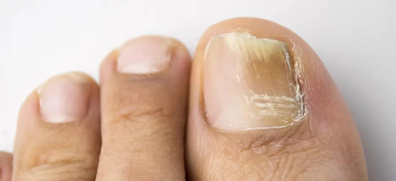 Leczenie grzybicy paznokci dermatolog