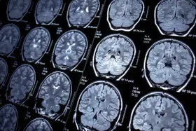 Przekroje mózgu na rezonansie magnetycznym, ukazujące jego strukturę. Badanie może pomóc w diagnozowaniu schorzeń, takich jak epilepsja.